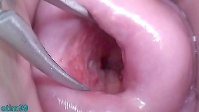chinese wife Open Cervix wide to watch inside Uterus
